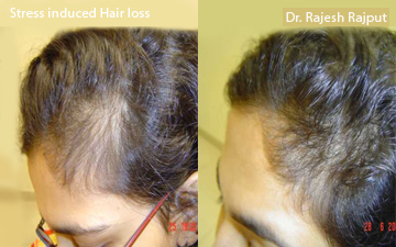 female-hair-transplant-17 | Hairlossindia