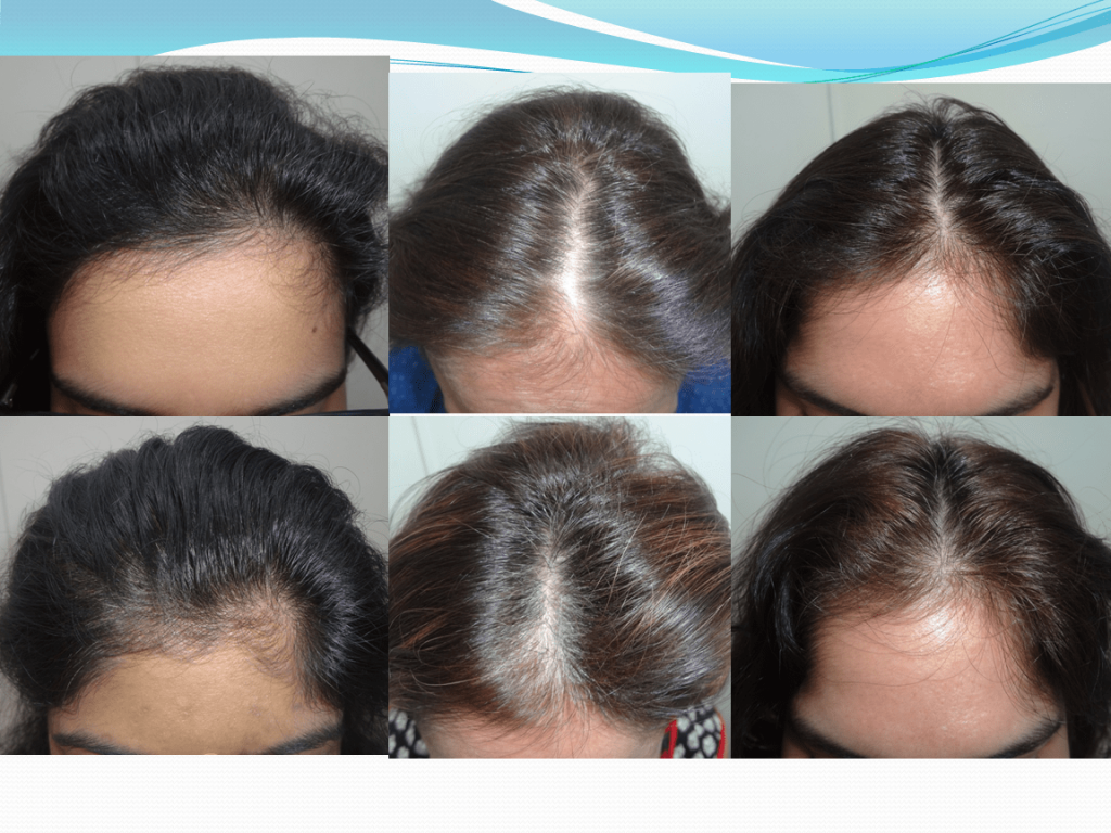 Patent granted to Nutrigenetics Hair loss treatment | Hairlossindia