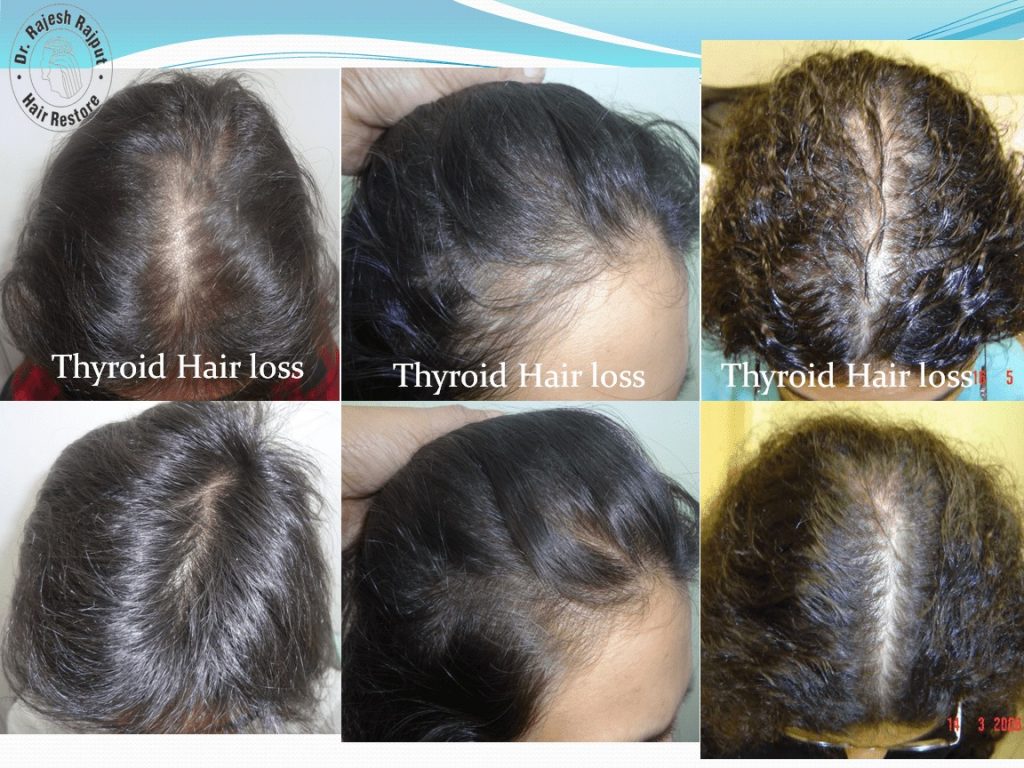 Patent granted to Nutrigenetics Hair loss treatment | Hairlossindia