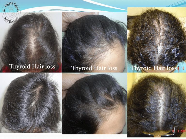 Thyroid01 Hairlossindia