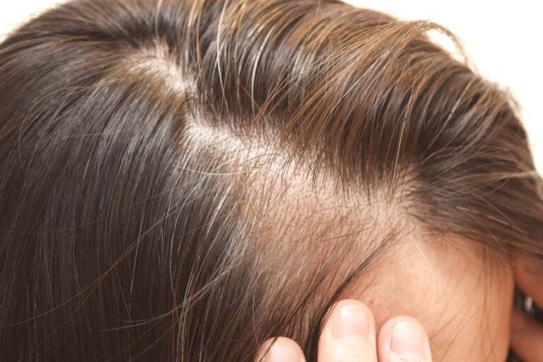 Why First-Line Hair Loss Treatments Sometimes Fall Short